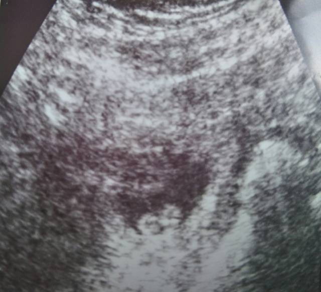 Sonar photo of fetus at eight weeks
